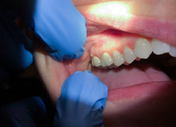Best Emergency Dentist for Lost Fillings or Crowns in Sumrall, MS